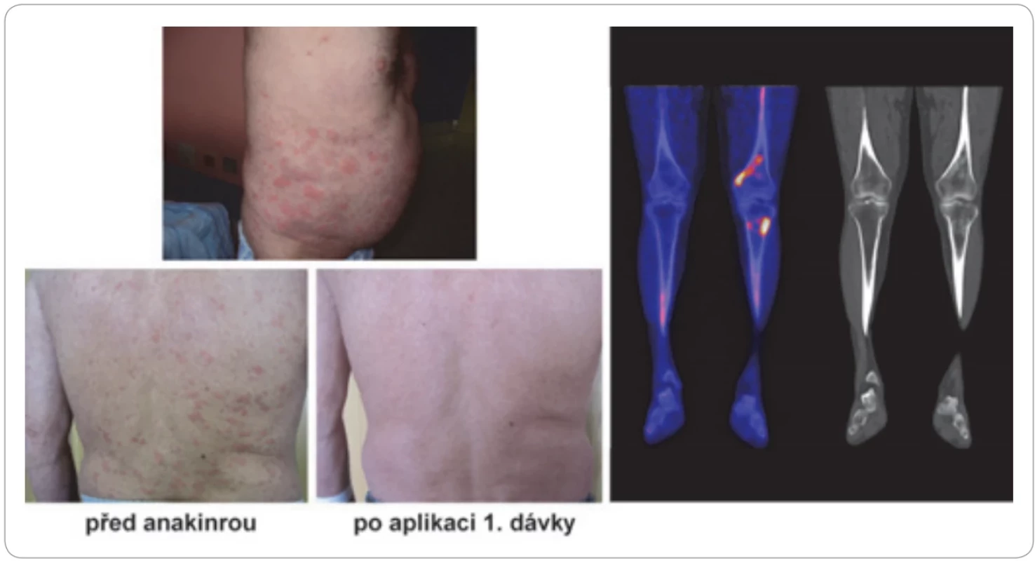 Syndrom Schnitzlerové. Atakovitě recidivující chronická kopřivka, monoklonální imunoglobulin, artralgie, osteosklerotické změny (nejcitlivěji je zobrazí NaF-PET/CT vyšetření, viz vpravo dole), zvýšené laboratorní markery zánětu.