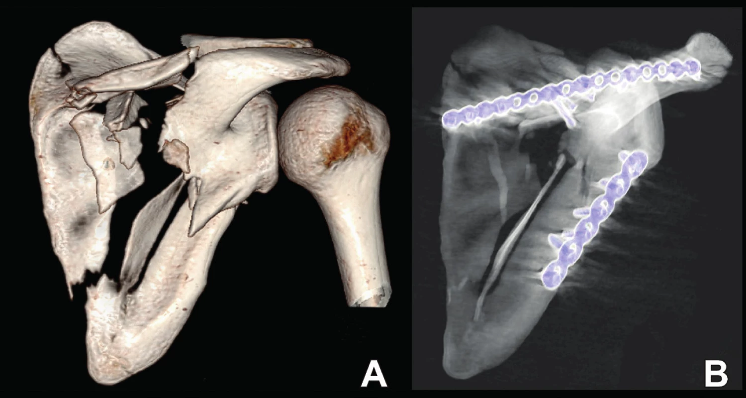 Osteosyntéza zlomeniny anatomického těla: A – situace po úrazu; B – situace po operaci.
Fig. 11: Internal fixation of anatomic body: A – post-injury radiograph; B – postoperative radiograph.