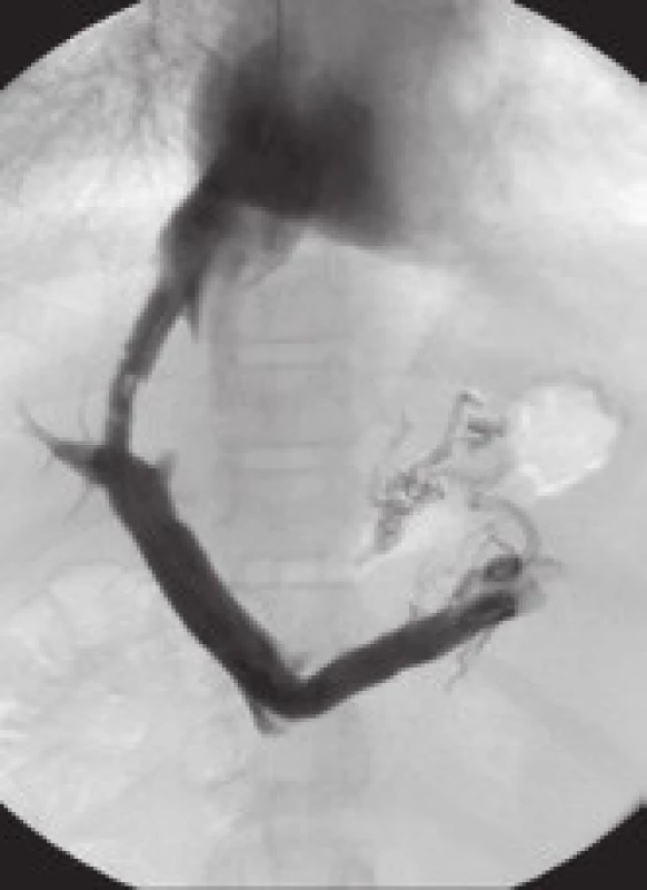 Akutní trombóza zkratu (dva dny po zavedení TIPS).
Fig. 4. Acute thrombosis of the shunt (two days after the introduction of TIPS).