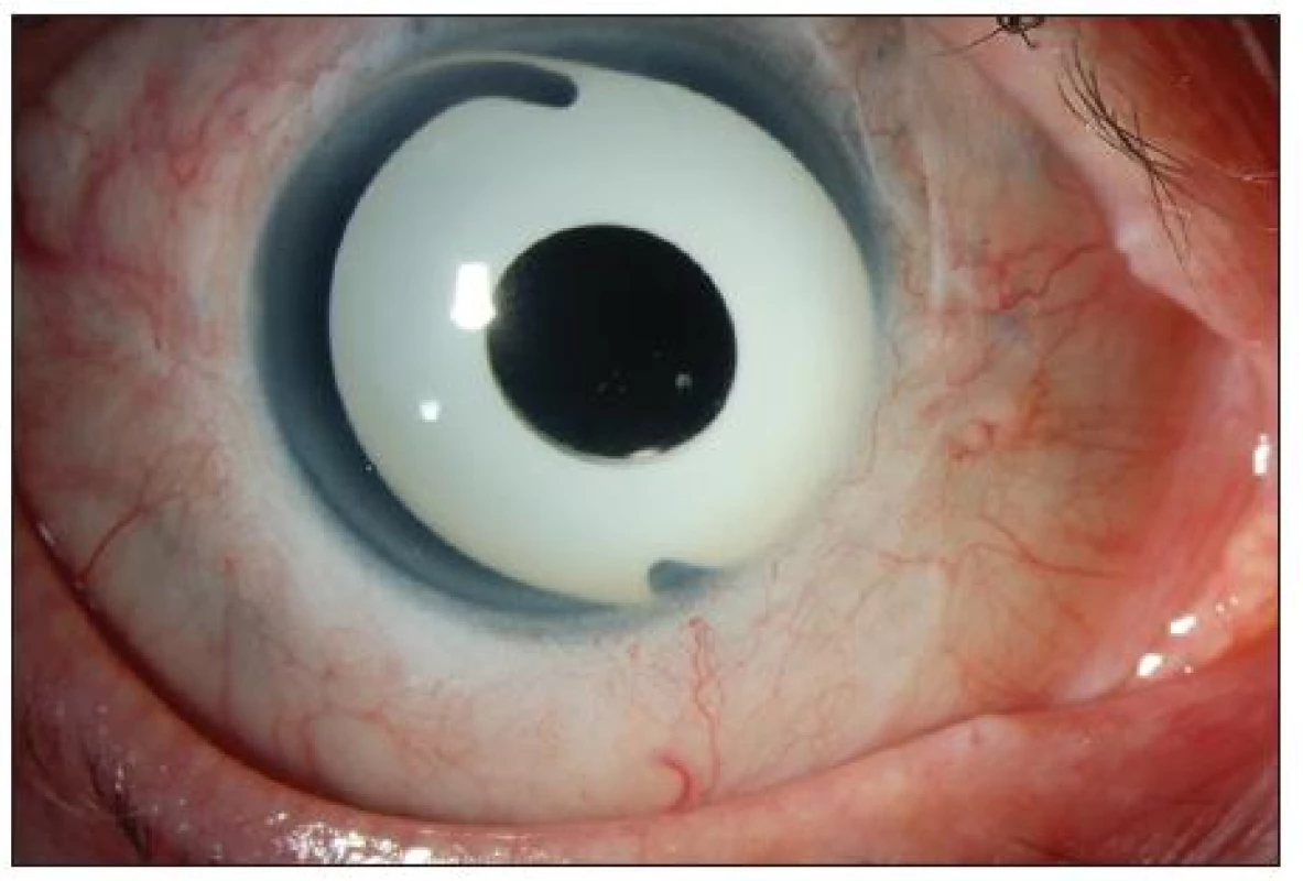 Nález po implantací modré PC IOL Ophtec