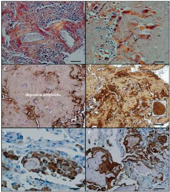 Rozdílnost imunohistochemických metod s pomocí komerční protilátky a s pomocí protilátky vyrobené v laboratoři prof. Westermarka.
A – depozita amyloidu znázorněná dichroizmem v bavení kongo červení, B – variantní depozita amyloidu s palisádovitým uspořádáním, znázorněná dichromizmem v barvení kongo červení, C – velmi slabý signál na λ řetězce v amyloidu použitím komerční protilátky, maximum pozitivity je mimo depozita amyloidu, D – podstatně silnější signál na λ řetězce použitím nekomerční monoklonální protilátky, maximum pozitivity je v palisádovitých formacích (viz výřez), E – mononukleární fagocyty v sousedství amyloidu, F – mnohojaderné fagocyty obklopující masy amyloidu
