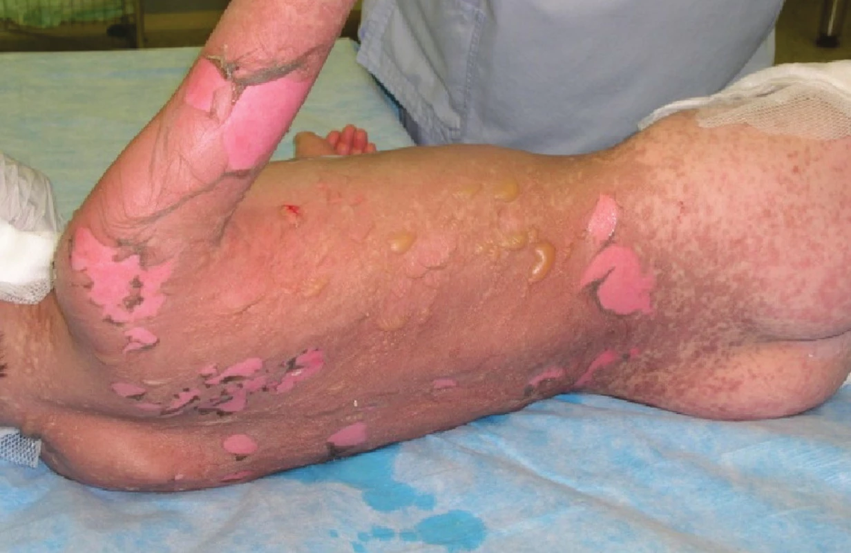 Epidermolýza a exfoliace na zádech, hýždích a pravé paži druhý den po přijetí
Fig. 1: Epidermolysis and exfoliation on the back, buttocks and the right arm on the second day following the patient’s admission