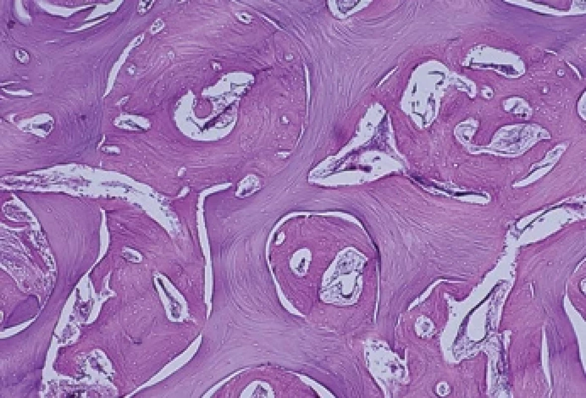 Histologický obraz sklerotické kosti lebky. Nově vytvořená vitální kost se přebarvuje do modra, na rozdíl od kosti červeně zbarvených nekrotických částí. Barveno hematoxylinem a eozinem.