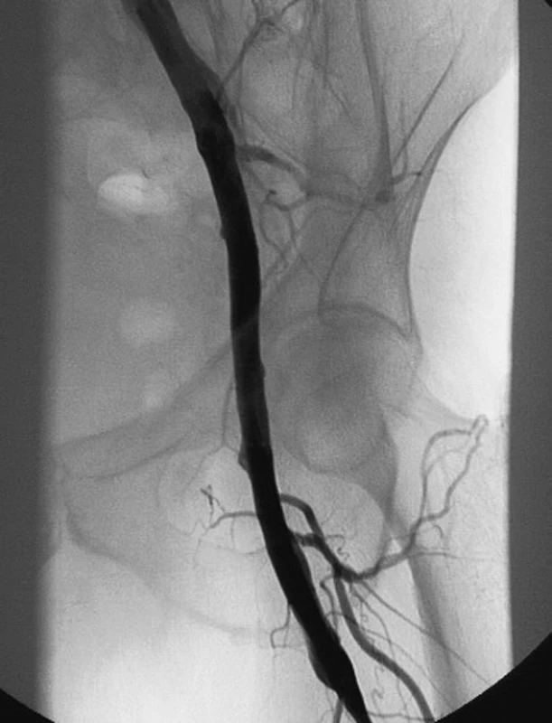 Kontrolní angiografie prokazuje dobrou průchodnost a morfologii iliako-profundálního bypassu vlevo autologní hlubokou žilou z dolní končetiny
Fig. 6. Angiograph of the autologous lower extremity deep vein graft in the left iliac-femoral position, showing good graft morphology and its patency
