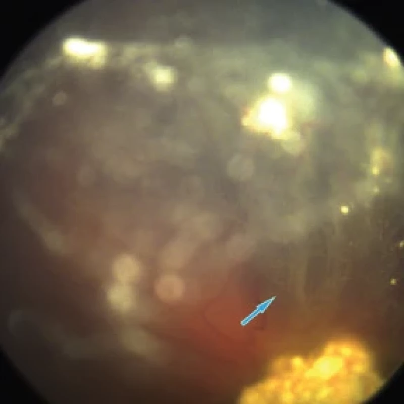 Classification of vitreous seeds: dust