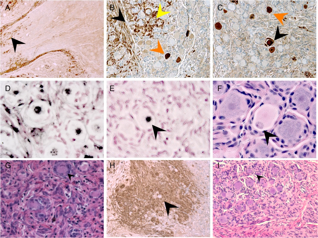 VZV spread in DRG xenografts.