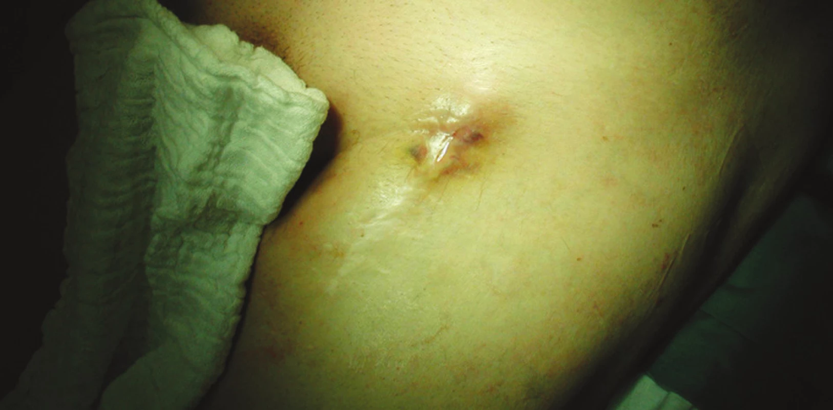Píštěl s hnisavou sekrecí v levém třísle
Fig. 1. Fistula with purulent discharge in the left groin