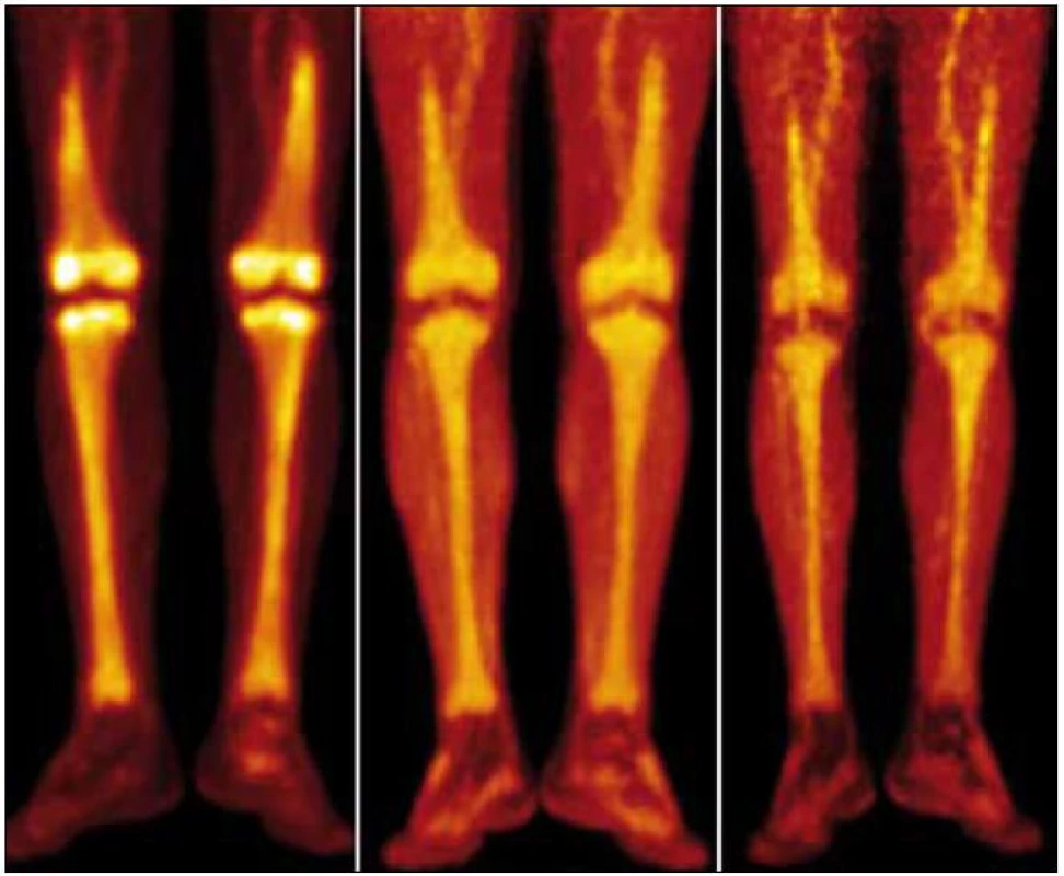 Srovnání PET-CT akumulace fluorodeoxyglukózy při PET-CT vyšetření před léčbou, v průběhu léčby a po ukončení léčby. PET-MIP (maximum intensity projection – MIP) v barevné škále „Hot Body“. Studie 8/2009 vlevo, 4/2010 uprostřed, 8/2010 vpravo. Je patrný pokles metabolické aktivity ve skeletu dolních končetin, nicméně i u poslední studie je výrazně vyšší než bývá obvyklé u fyziologických nálezů.