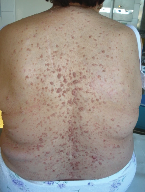 Neurofibromatóza kůže
Fig. 1: Neurofibromatosis of the skin