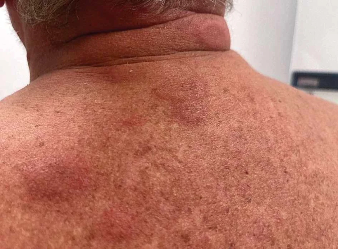 Neutrofilní dermatóza u pacienta se syndromem VEXAS