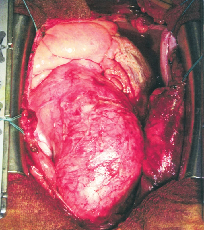 Dilatovaná vzestupná aorta
Fig. 1. The ascending aorta – dilated