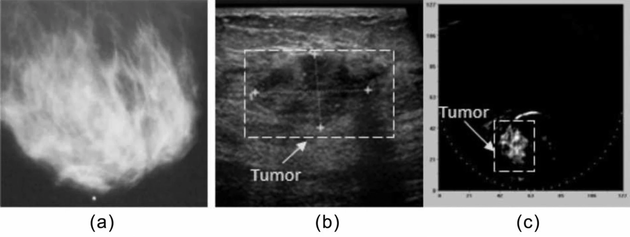 Příklad klinického využití fotoakustické tomografie.
(a) mediolaterální mamografie, (b) ultrasonogram,
(c) optoakustický obraz. Vysoký kontrast objektu v obraze
(c) svědčí pro zhoubný nádor. Přetištěno se svolením [15].