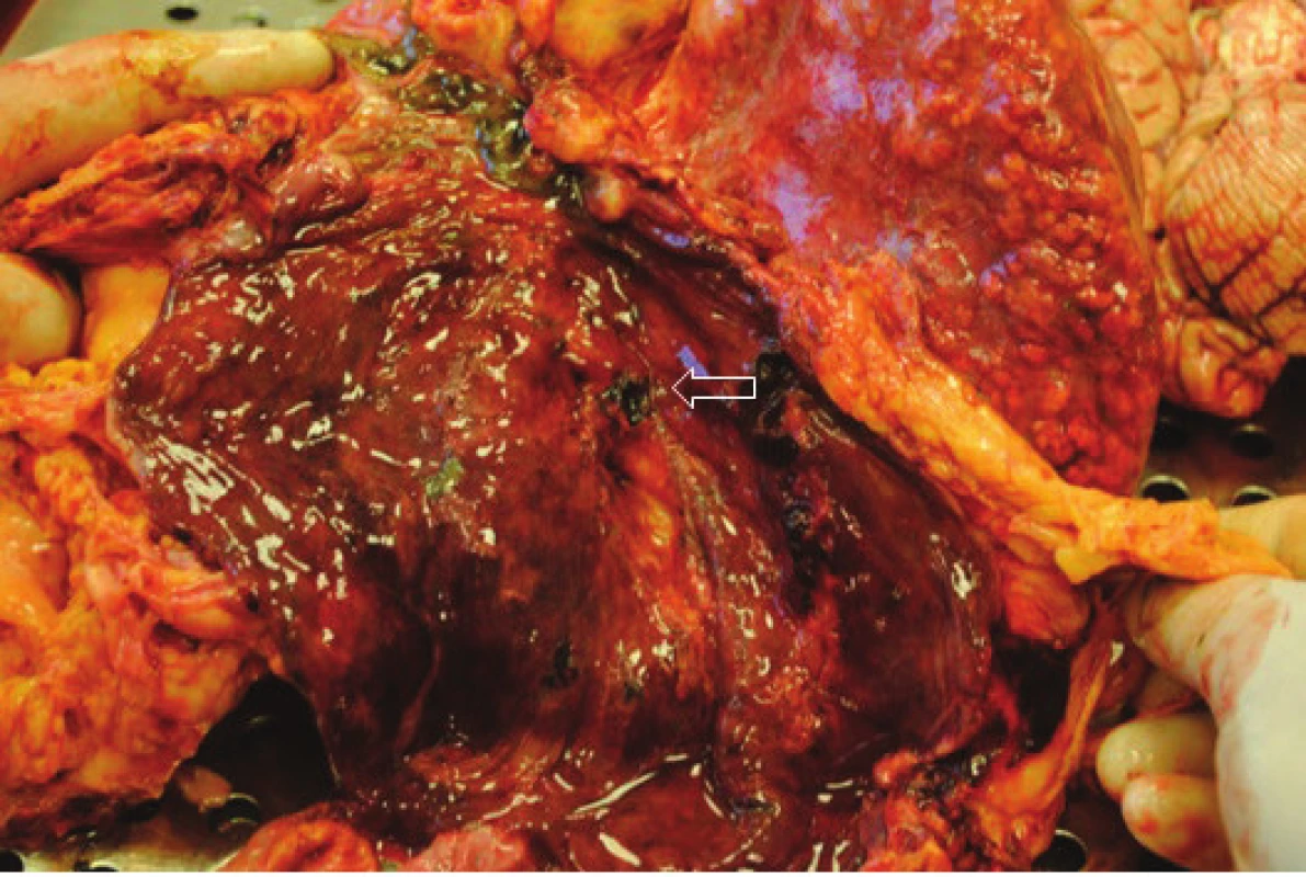 Sekční nález − sliznice žaludku se známkami portální hypertenzní gastropatie
Fig. 5: Autopsy fading − entricular mucosal signs of portal hypertensive gastropathy