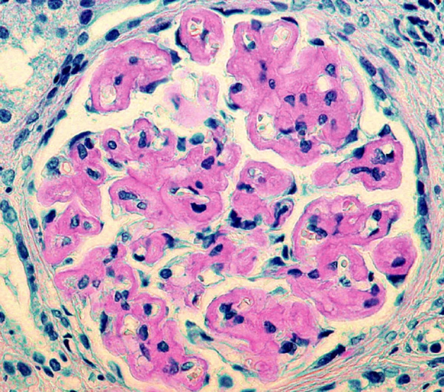 Neobvykle rozložená depozita amyloidu lemující glomerulární bazální membrány (barvení Saturnovou červení; objektiv 40krát)