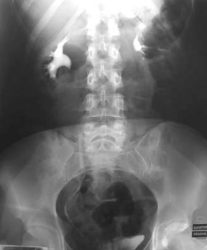 Kontrolní vylučovací urografie 22 měsíců od úrazu.