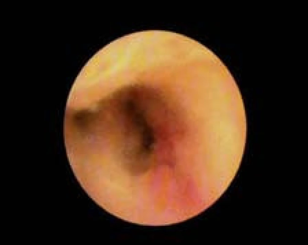 Pohled do společného žlučovodu.
Fig. 3. View of a common bile duct.