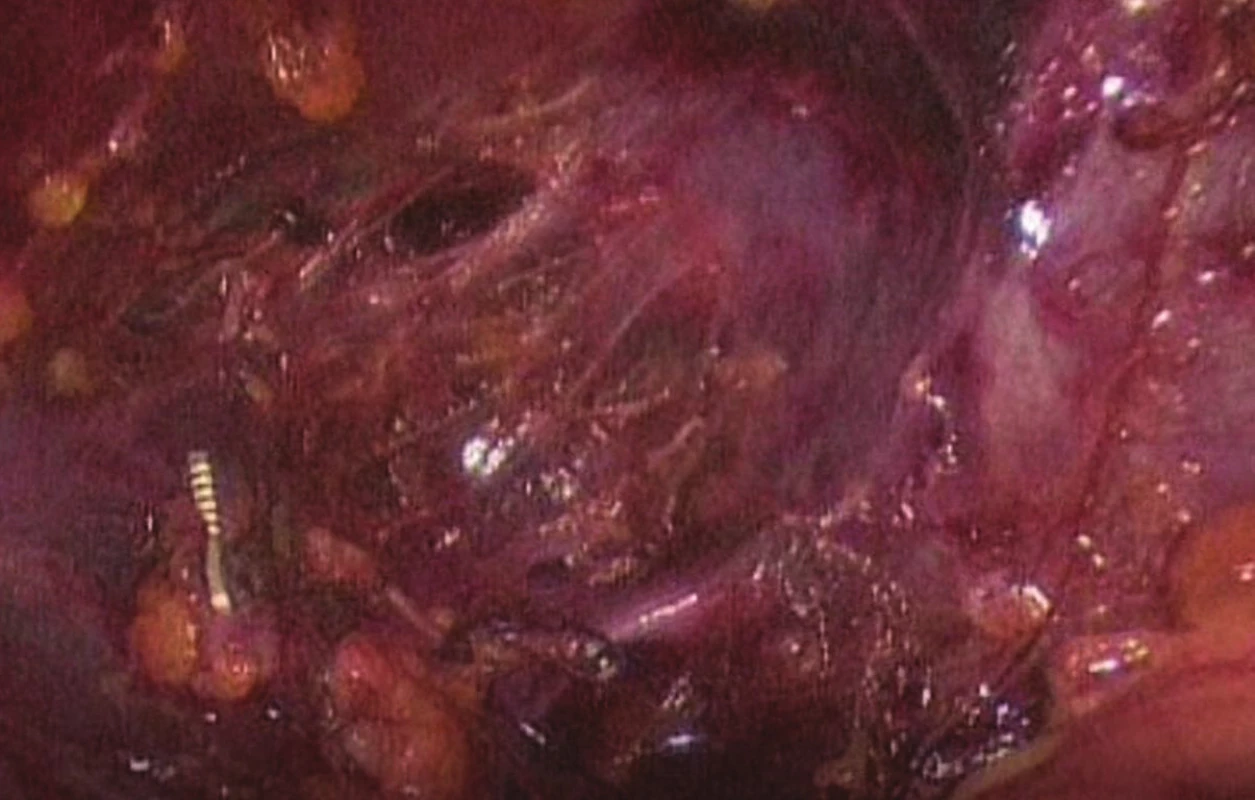 Sutura vena cava inferior
Fig. 2: Suture of inferior vena cava