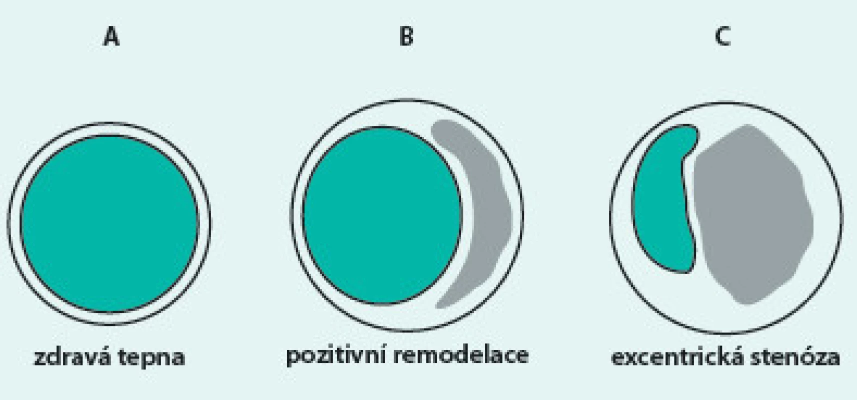 Cévní remodelace