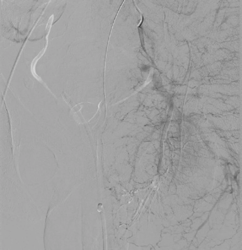 <i>Angiografie – stav po selektivní embolizaci</i>
Fig. 5. <i>Angiography – after selective embolisation</i>