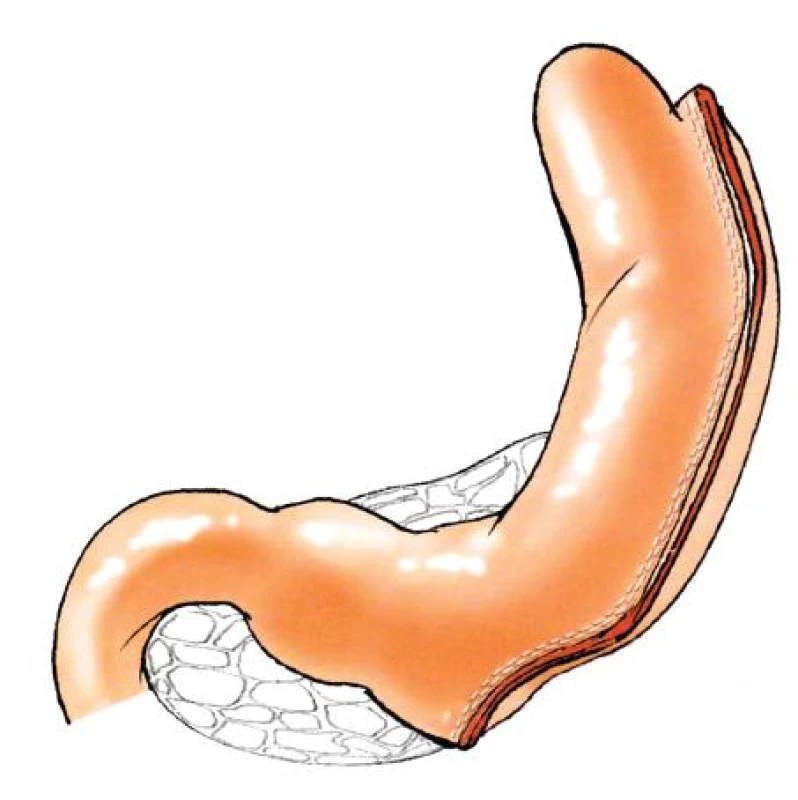 Sleeve gastrektomie