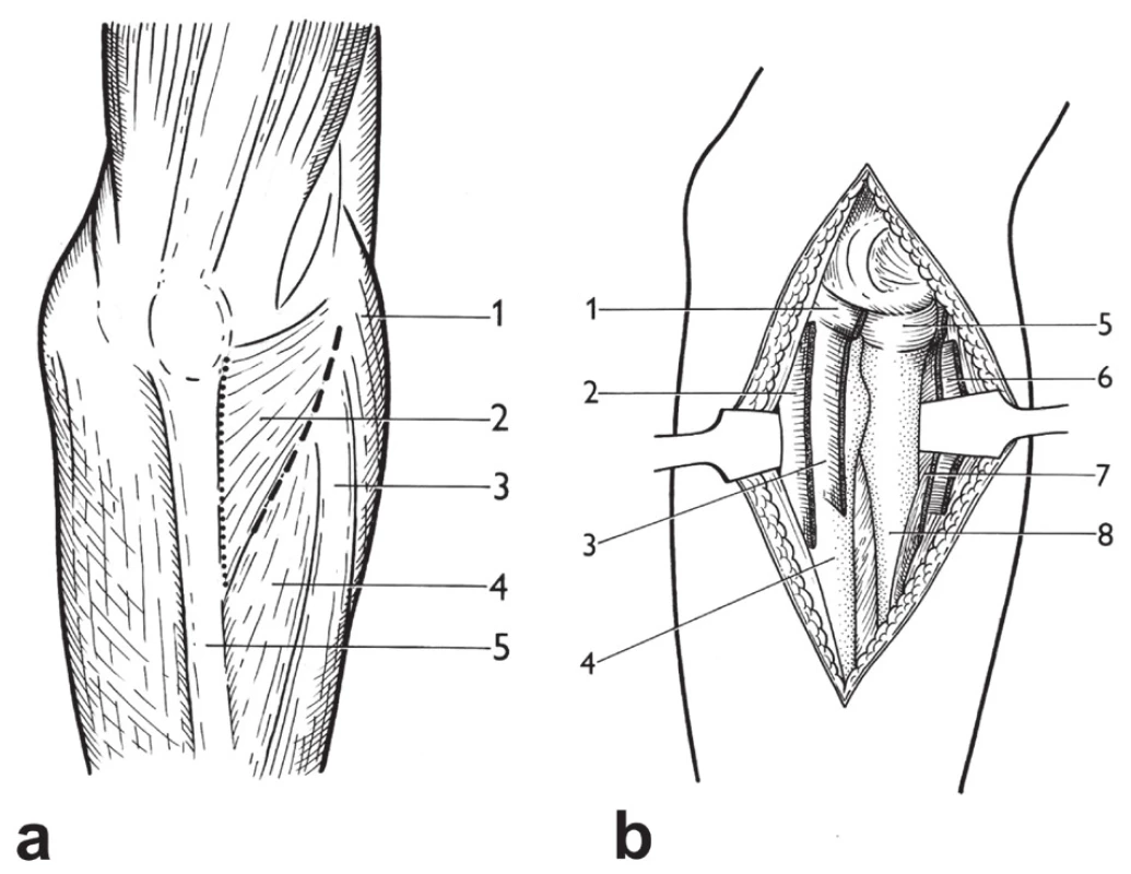 Boydův přístup: a – srovnání incize u Boydova přístupu (tečkovaně) a Kocherova přístupu (čárkovaně), 1 – picondylus lateralis humeri, 2 – m. anconeus, 3 – m. extensor digitorum, 4 – m. extensor carpi ulnaris, 5 – ulna; b – dokončený Boydův přístup: 1 – dorzální část lig. anulare radii, 
2 – úpon m. anconeus na ulnu, 3 – úpon m. supinator na ulnu, 4 – diafýza ulny, 5 – caput radii, 
6 – ventrálně odtažený m. anconeus, 7 – ventrálně odtažený m. supinator, 8 – diafýza radia. <i>(Převzato z Bartoníček J. Operační přístupy u zlomenin hlavičky a diafýzy rádia. Acta Chir Orthop Traumatol Cech 1988;55:497−516.)</i>
Fig. 22: Boyd approach: a – comparison of incision in Boyd approach (dotted line) and Kocher approach (dashed line), 1 – lateral epicondyle of humerus, 2 – anconeus, 3 – extensor digitorum, 
4 – extensor carpi ulnaris, 5 – ulna; b – completed Boyd approach: 1 – posterior part of radial annular ligament, 2 – insertion of anconeus on ulna, 3 – insertion of supinator on ulna, 4 – ulnar shaft, 5 – radial head, 6 – anteriorly retracted anconeus, 7 – anteriorly retracted supinator, 8 – radial shaft. <i>(Reprinted from Bartoníček J. [Surgical approaches in fractures of the head and shaft of radius]. Acta Chir Orthop Traumatol Cech 1988;55:497−516.)</i>