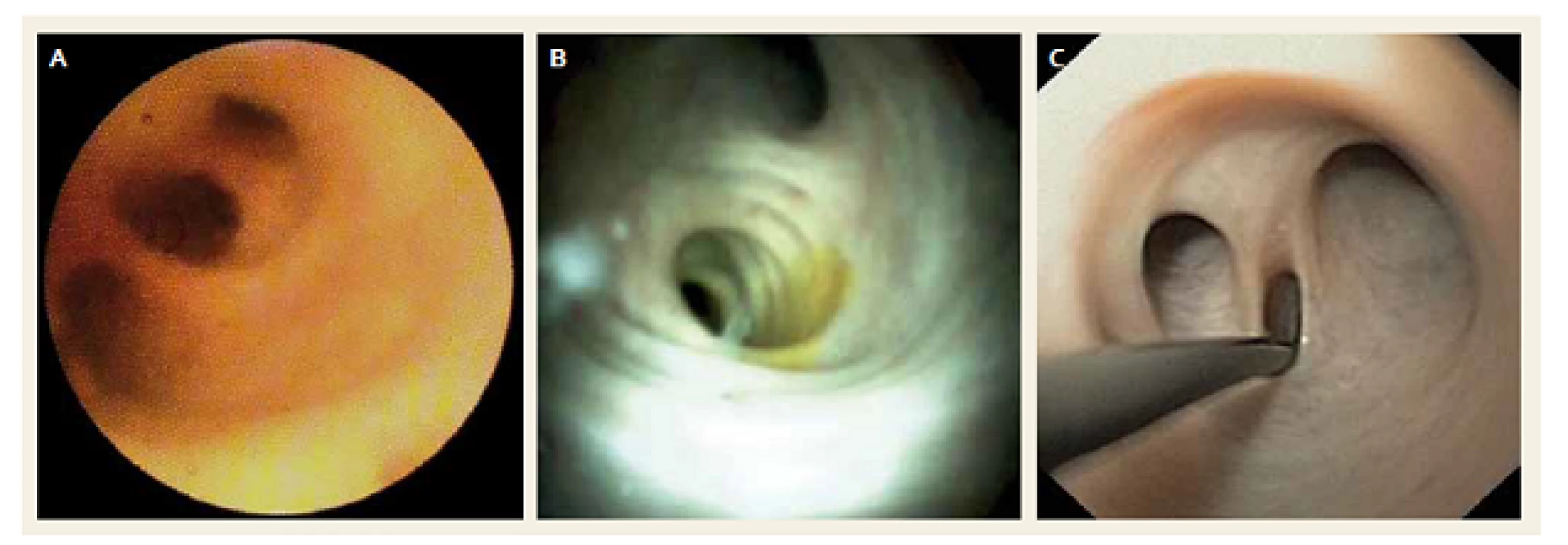 Normální žlučové cesty – A. SOC, Spyglass<sup>®</sup> Legacy, B. SOC, Spyglass™ DS, C. DPOC, transnazální endoskop.
Fig. 1. Normal bile ducts – A. SOC, Spyglass<sup>®</sup> Legacy, B. SOC, Spyglass™ DS, C. DPOC, transnasal endoscope.