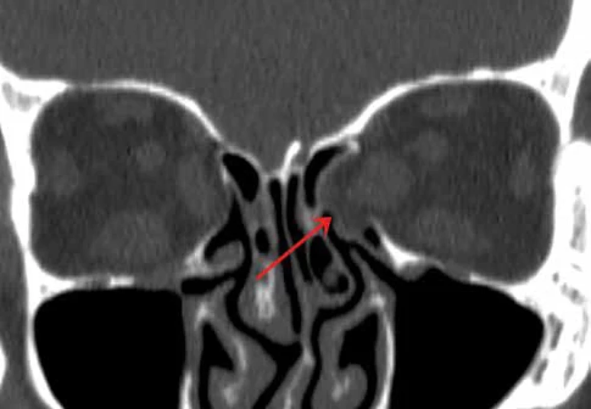 Výpočetní tomografie – nález po dekompresi orbity vlevo (šipka)
