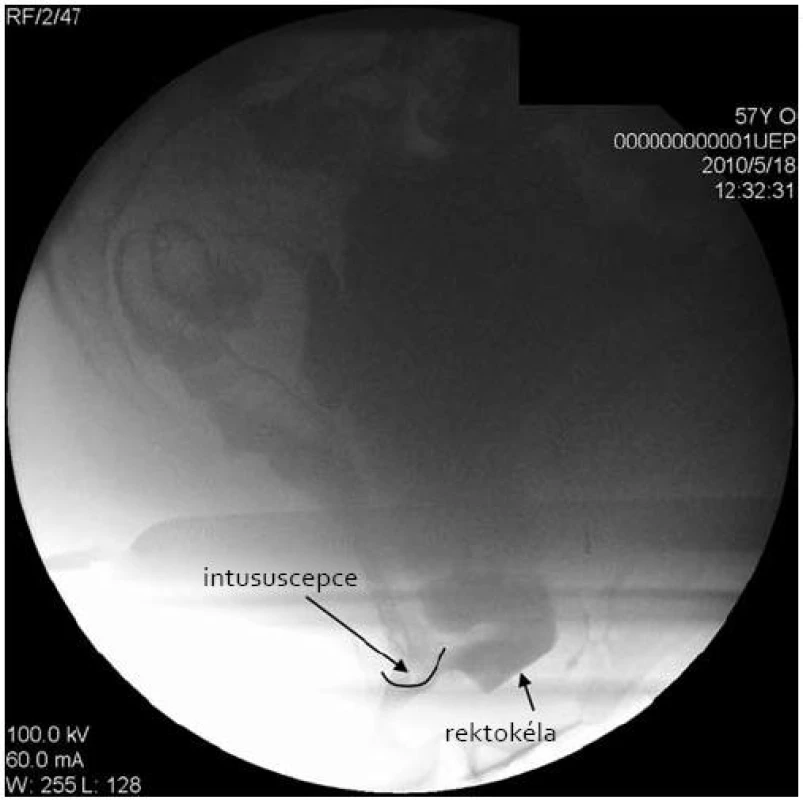Defekace – velká rektokéla 7 cm a intususcepce horního rekta nad análním kanálem, bránící evakuaci obsahu rektokély.
Fig. 2. During defecation, a large rectocele (7 cm) and upper rectal intussusception blocking contrast material evacuation were detected.
Foto: prim. J. Frydrych.