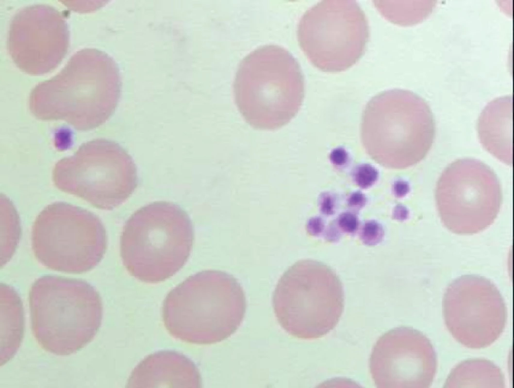 Pseudotrombocytopenie – snížení tendence trombocytů k agregaci (menší shluky) v nátěru periferní krve odebrané do K3 EDTA a po inkubaci ve vodní lázni o teplotě 37°C (počet trombocytů odečtených analyzátorem – 38 x 109/l).
