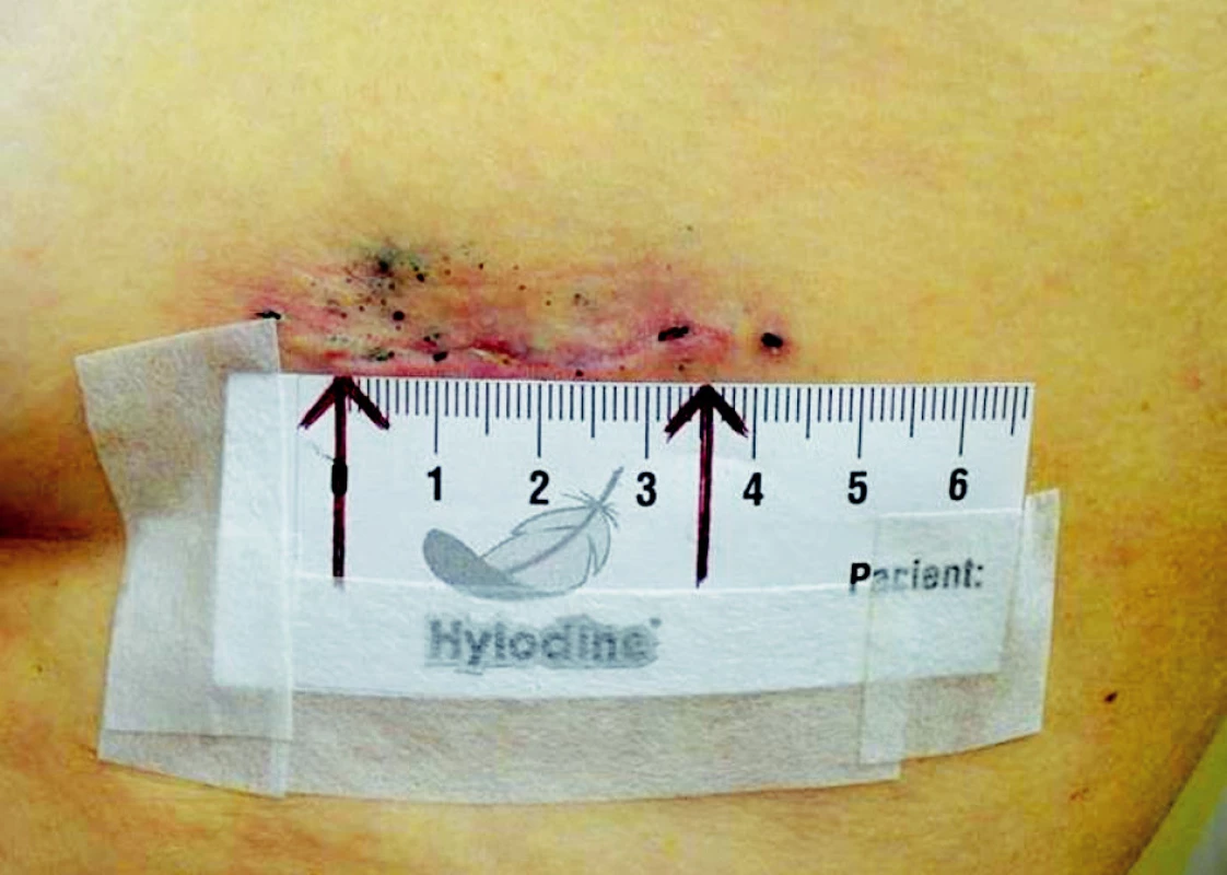 Jizvy po torakoskopické horní lobektomii vlevo –14 dnů po operaci
Fig. 2. Scars resulting from upper thoracoscopic lobectomy on the left- 14th postoperative day