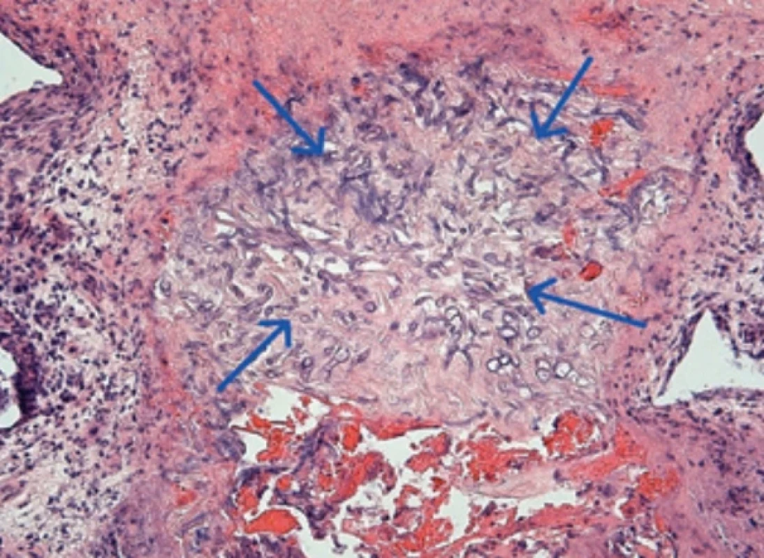 Histologický nález: mozgové tkanivo s fragmentami nešpecifi ckého zápalového granulačného tkaniva okolo nekrotických más obsahujúcich septované hýfy vláknitých mikroorganizmov, ktoré sa vetvia pod ostrým uhlom a sú zvýraznené špeciálnymi farbiacimi metodikami (PAS, gram, striebrenie) (hýfy – modré šípky). Fig. 3. Histological fi nding: brain tissue with fragments of nonspecific inflammatory granulation tissue surrounding necrotic masses containing septate hyphae of filamentous microorganisms, which branch at acute angles and are highlighted by special staining methods (PAS, gram, silver staining) (hyphae – blue arrows).