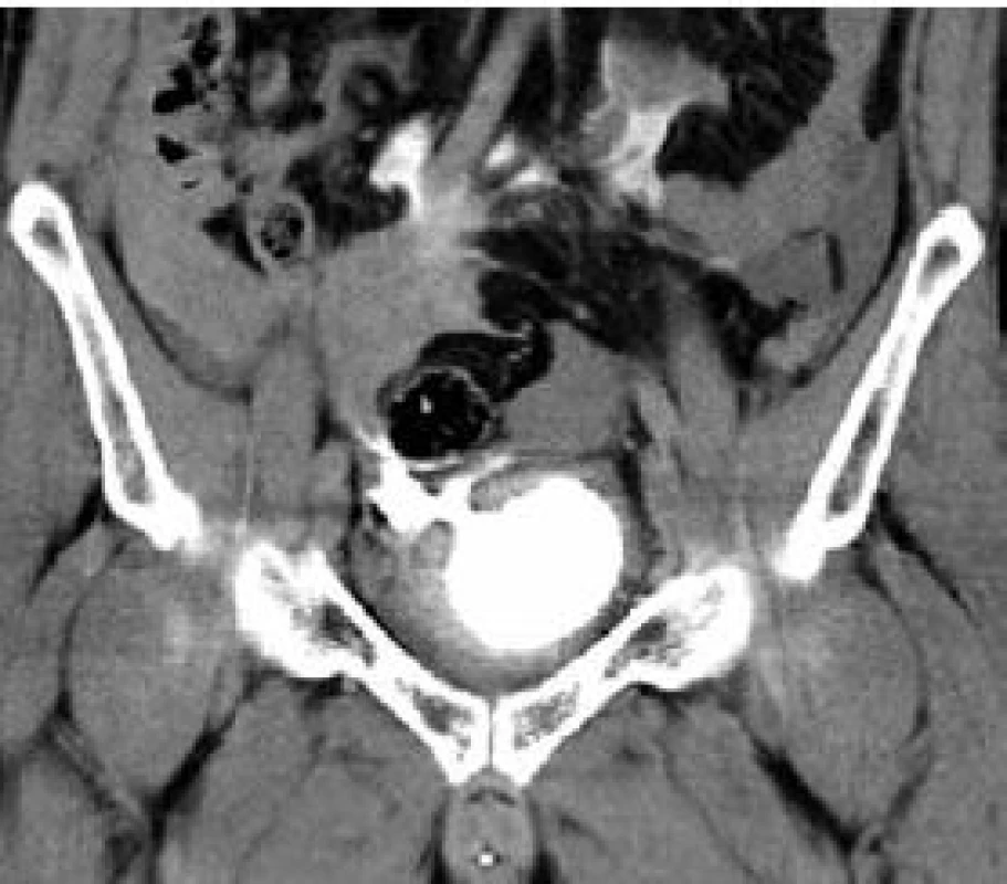 CT pánve (koronární řez) – intraperitoneální ruptura močového měchýře (pravý přední kvadrant)
Fig. 5. CT of pelvis (coronal section) – intraperitoneal rupture of the urinary bladder (front right quadrant)