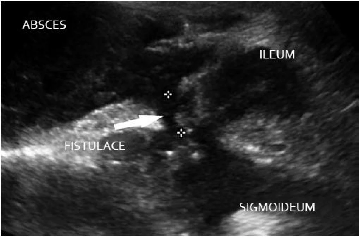Crohn, komplikace – suprapubický absces, aktivní zánětlivé postižení ilea a sigmoidea, entero sigmoideální fistulace.
Fig. 3. M. Crohn, complications – suprapubic abscess, acute inflammation of the ileum and sigmoid, entero-sigmoid fistulation.