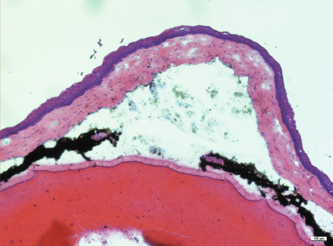 Histologický řez přední částí oka, komorová tekutina je zkalená, duhovka je překrvená, jsou přítomny přední i zadní synechie. Za duhovkou je čočka, která fyziologicky vyplňuje velkou část oka. Zvětšení 10x