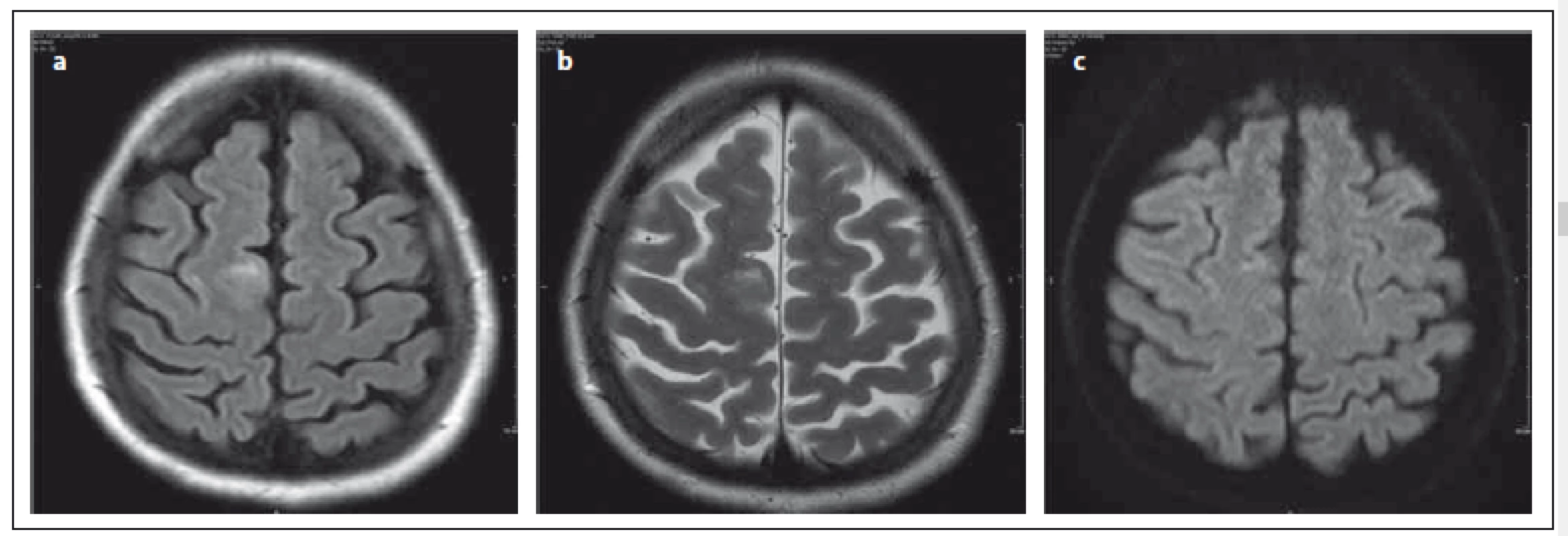 Relaps remitentní forma RS, pacientka léčena natalizumabem od roku 2009, JCV pozitivní, klinicky stabilní.
Fig. 1. Female patient with RRMS; treated with natalizumab since 2009, JCV positive, clinically stable.