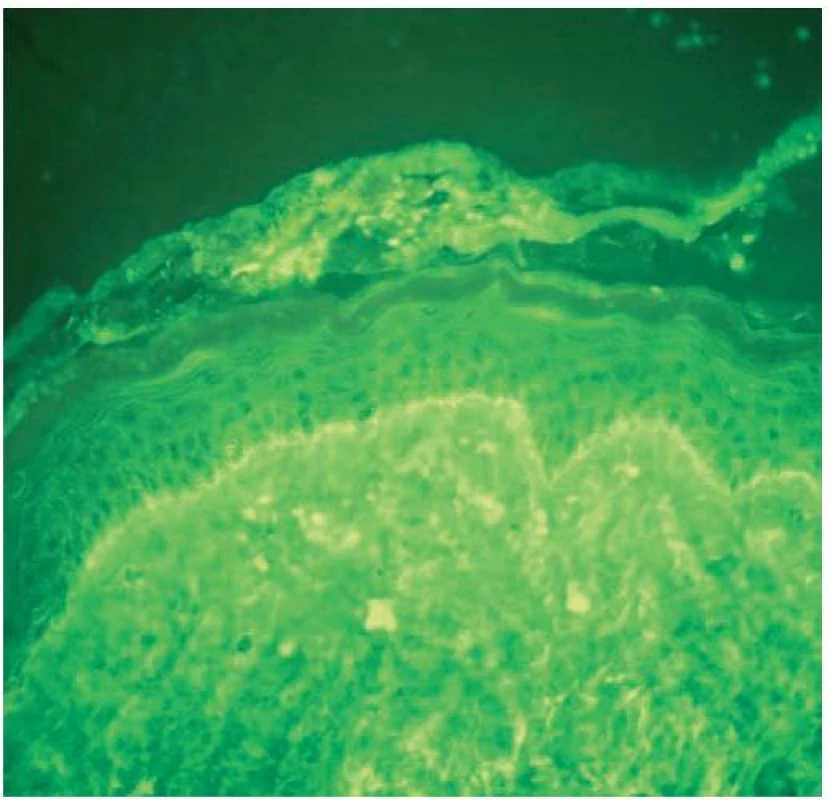 Diskoidní lupus erythematodes, přímá imunofluorescence, jemně zrnitá depozita IgG v dermo epidermálním rozhraní – „lupus band“