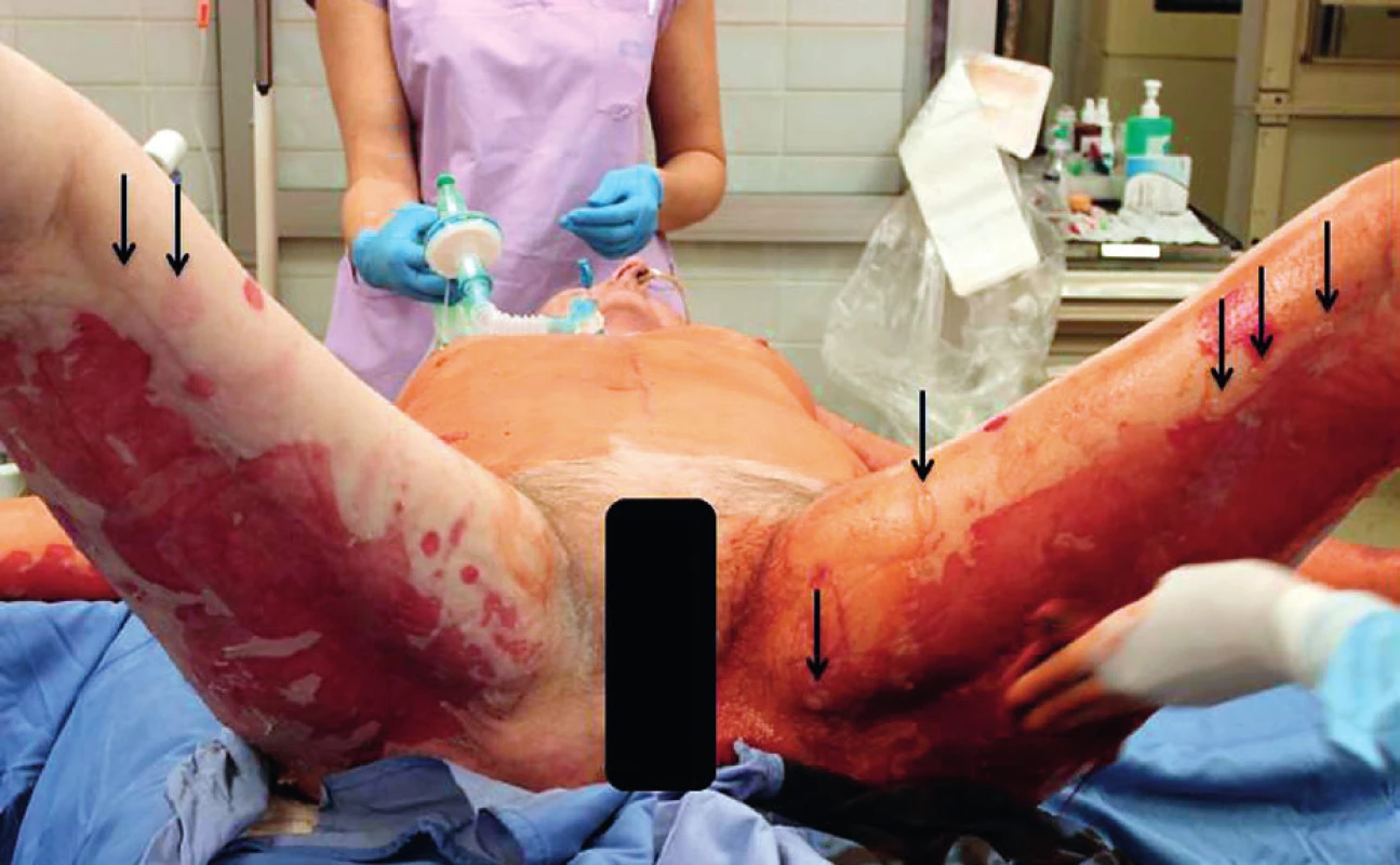Rozsah exfoliovaných ploch v oblasti dorzální strany stehen
Fig. 2. Extent of exfoliated surfaces on the posterior thighs
