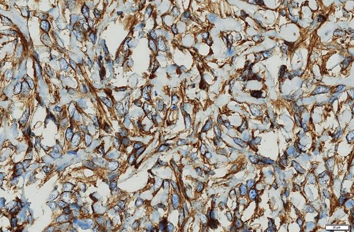 Nádorové buňky exprimovaly marker CD34. Immunohistologie, měřítko 20 μm.