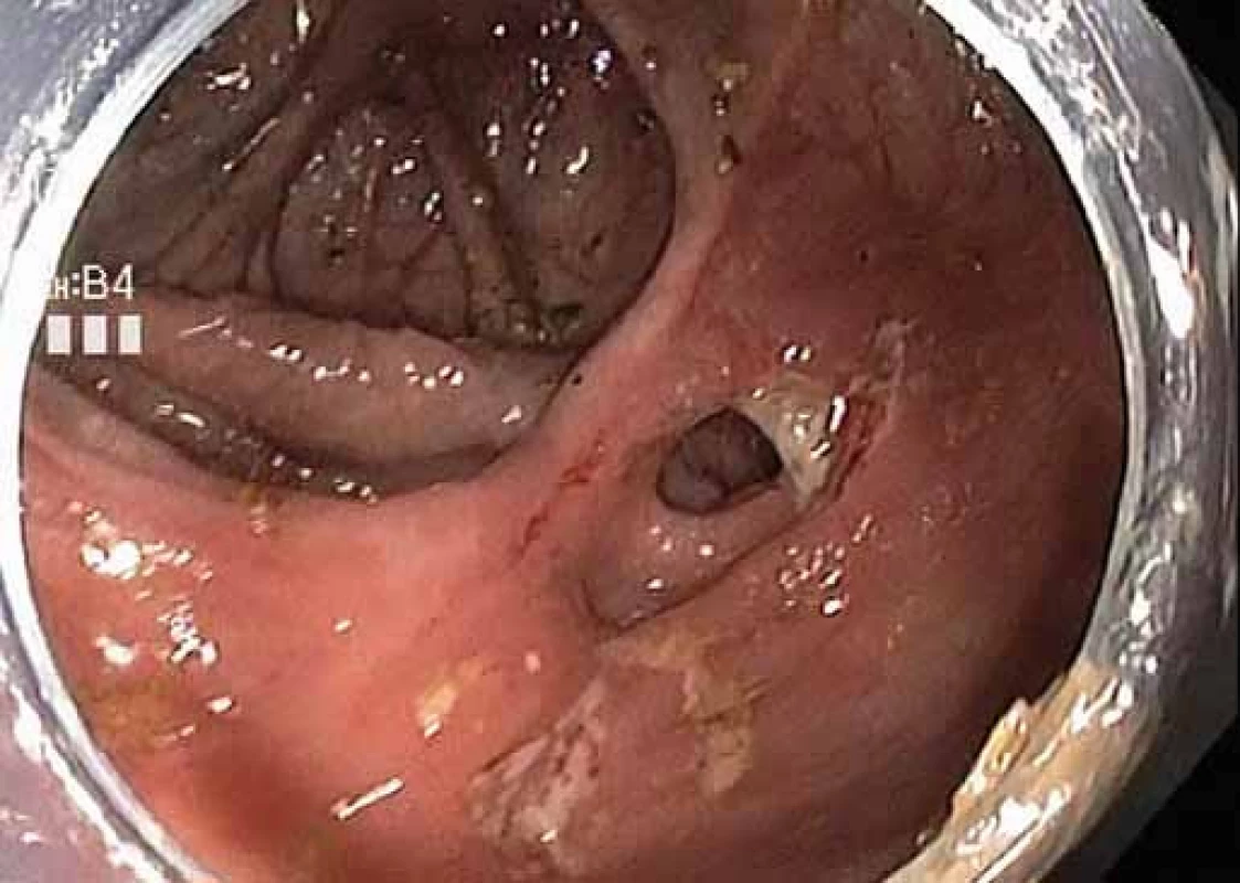 Koloskopicky bez známek rekurence nemoci – oblast ileokolické anastomózy.
Fig. 4. Coloscopic image without evidence of disease recurrence – ileocolic anastomosis.