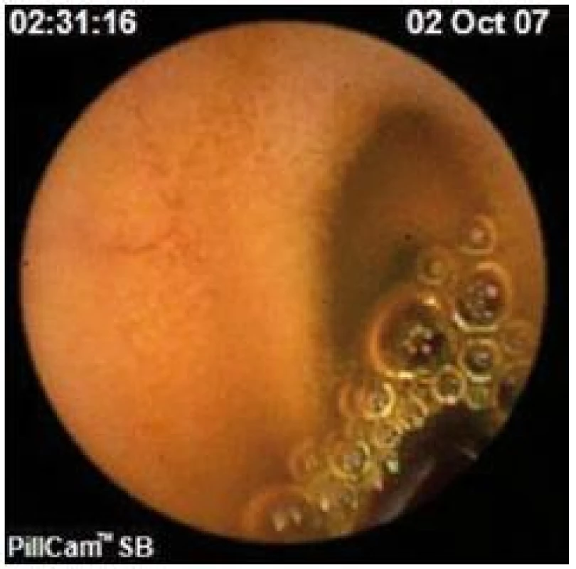 Normálny nález z vyšetrenia kapsulovou enteroskopiou.
Fig. 3. Normal finding using capsule enteroscopy.