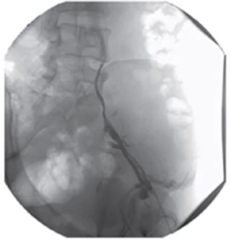 Stenóza pánevního řečiště
Fig. 3: Stenosis of pelvic vasculature