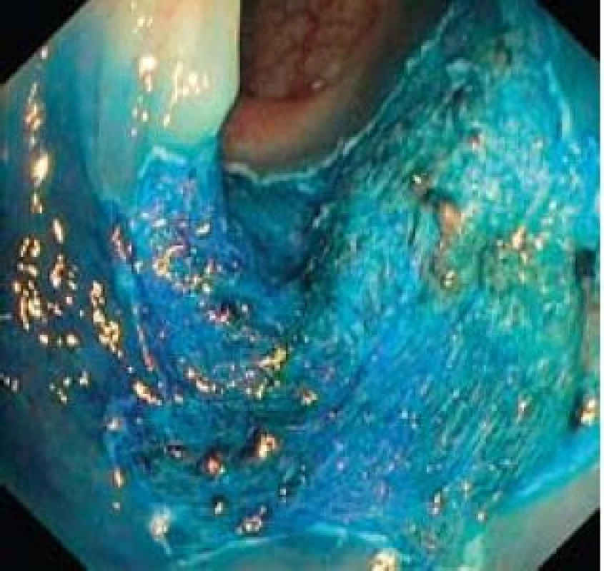 Spodina po kompletní endoskopické resekci.
Fig. 7. Resection base after complete endoscopic resection.