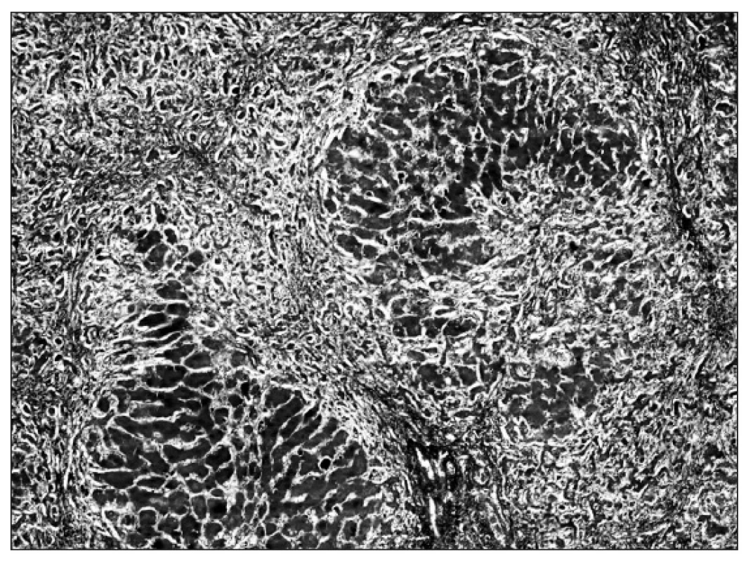 Cirhóza pečene – pseudolobulárna transformácia parenchýmu (Mallory, 40x).
Fig. 4. Liver cirrhosis – pseudolobular transformation of parenchyma (Mallory, 40x).