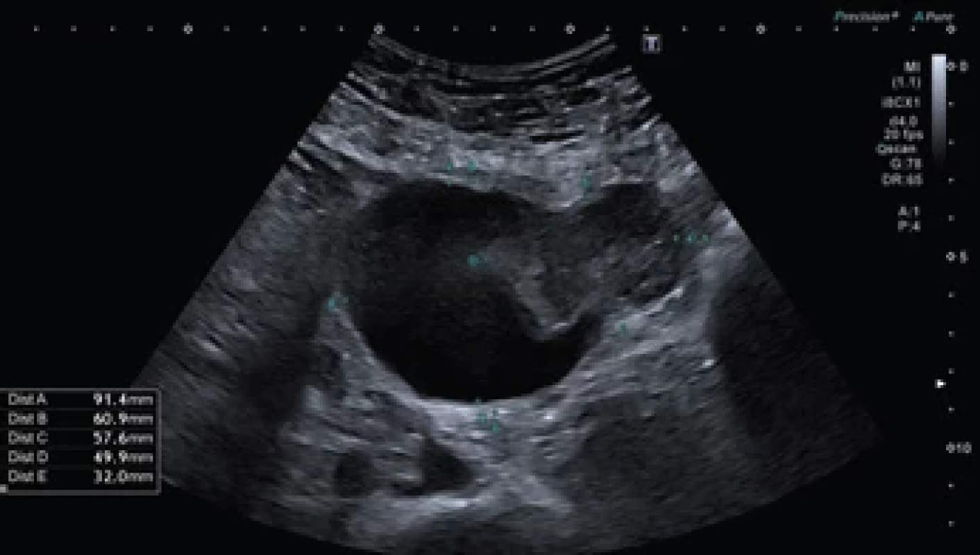 Ultrazvukový snímek tumoru. Fig. 1. Ultrasound scan of the tumour.