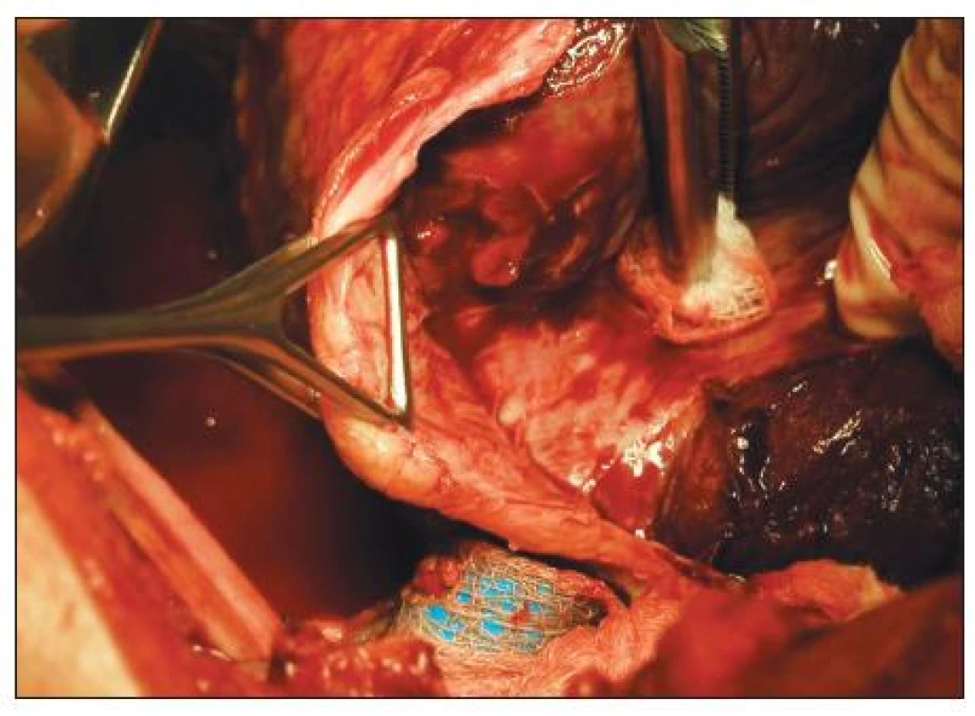 Peroperační snímek dekortikace otevřenou cestou chronického poúrazového empyému
Fig. 5. Intraoperative view during open surgery decortication in chronic posttraumatic empyema