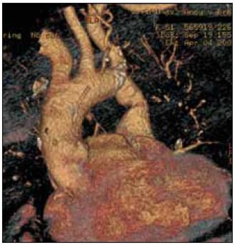 CT angiografia.