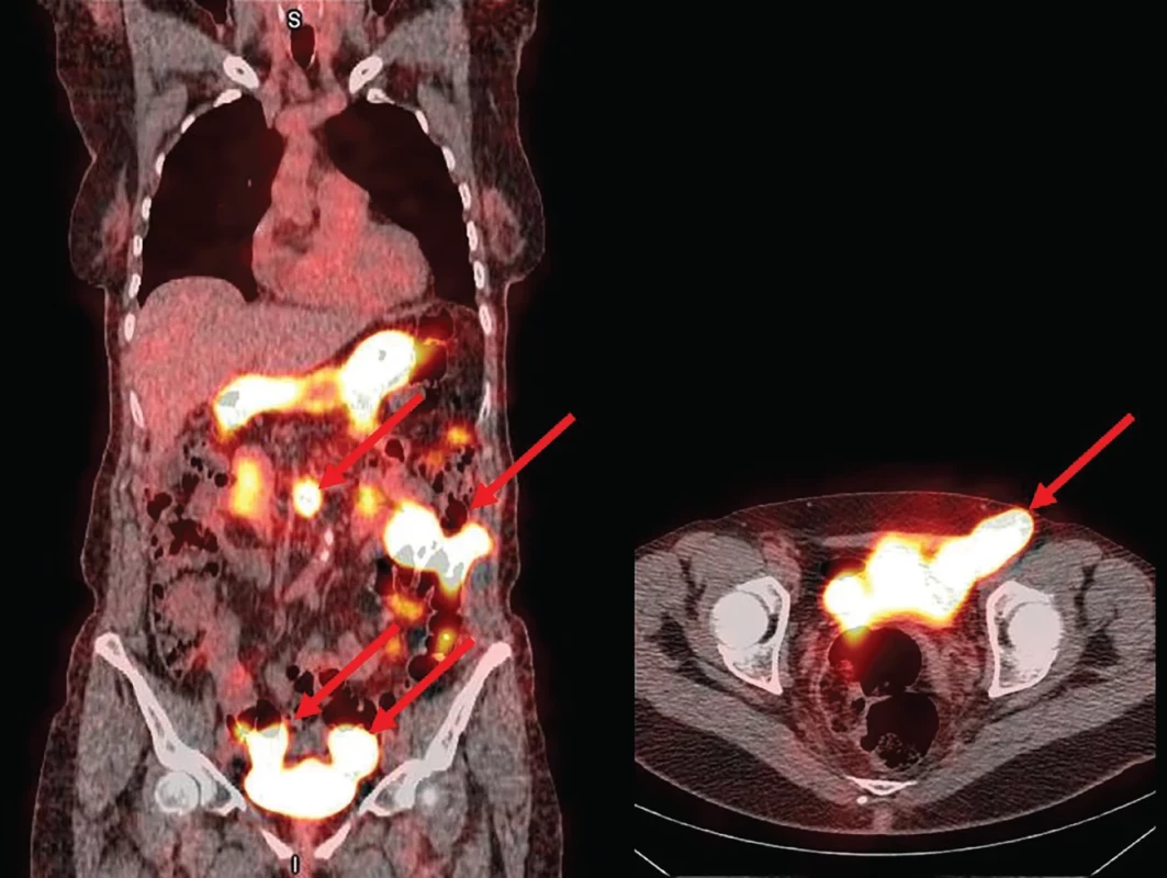 Obrazy SPECT/CT po aplikaci 99mTc-TO4