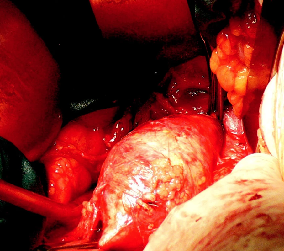 8. Resekce AAA s A-A náhradou ze střední laparotomie
Fig. 8. Resection of the AAA with A-A implantation performed via the midline incision