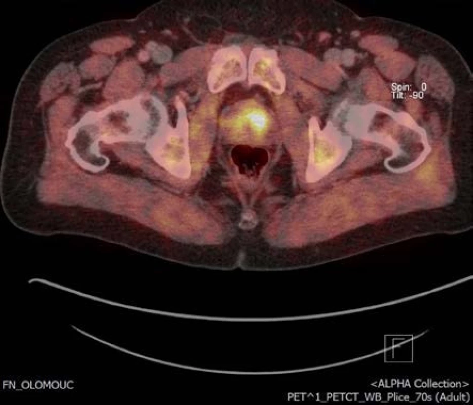 Obr. 3. Ložisko v levém laloku na 18-F-fluorocholin PET/CT příčný řez
Fig. 3. Focus of the tumor in left anterior zone of the prostate on 18F-fluorocholine PET/CT transversal section