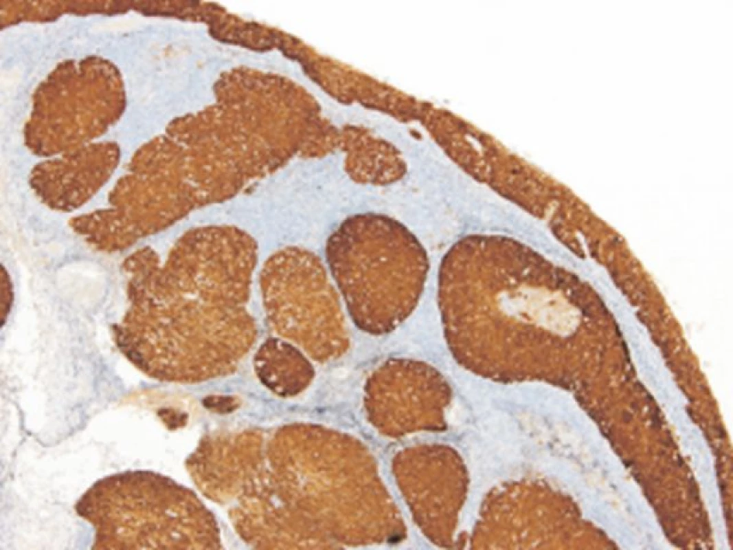 Silná difúzní exprese proteinu p16 u HNSCC. (CINtec Histology V-kit, zvětšení 100x).